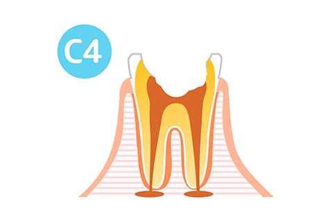 虫歯C４