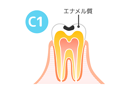 虫歯C0～1